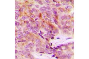 Immunohistochemical analysis of MRPS18A staining in human breast cancer formalin fixed paraffin embedded tissue section.