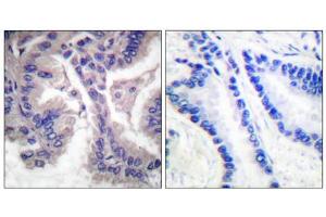 Immunohistochemical analysis of paraffin-embedded human lung carcinoma tissue, using Caspase 6 (cleaved-Asp162) antibody. (Caspase 6 antibody  (Cleaved-Asp162))