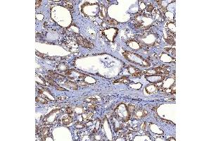 IHC analysis of PIG3/TP53I3 using anti-PIG3/TP53I3 antibody (ABIN7599280). (TP53I3 antibody  (AA 1-332))