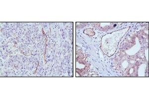Immunohistochemical analysis of paraffin-embedded human stomach cancer (left) and ovary cancer (right) tissues using eNOS antibody with DAB staining. (ENOS antibody)