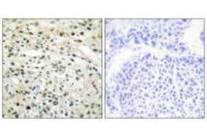 Immunohistochemistry analysis of paraffin-embedded human liver carcinoma tissue using DNMT3B antibody. (DNMT3B antibody  (N-Term))