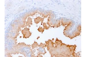 Formalin-fixed, paraffin-embedded human Prostate Carcinoma stained with AMACR Recombinant Mouse Monoclonal Antibody (rAMACR/1864). (Recombinant AMACR antibody  (AA 297-394))