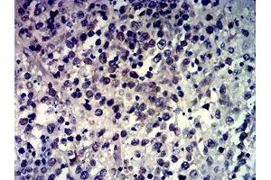 Immunohistochemical analysis of paraffin-embedded brain tumor tissues using MSH6 mouse mAb with DAB staining.