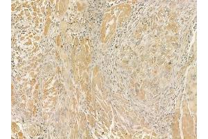 ABIN6262157 and ABIN6273254 at 1/100 staining human tongue carcinoma by IHC-P. (HBS1L antibody  (N-Term))
