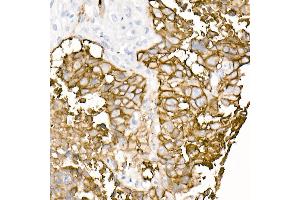 Immunohistochemistry of paraffin-embedded human lung squamous carcinoma tissue using TROP-2 Rabbit mAb (ABIN7271103) at dilution of 1:8100 (40x lens). (TACSTD2 antibody)