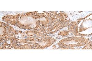 Immunohistochemistry of paraffin-embedded Human thyroid cancer tissue using RPL28 Polyclonal Antibody at dilution of 1:35(x200) (RPL28 antibody)