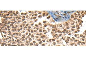 Immunohistochemistry of paraffin-embedded Human ovarian cancer tissue using XPO1 Polyclonal Antibody at dilution of 1:40(x200) (XPO1 antibody)
