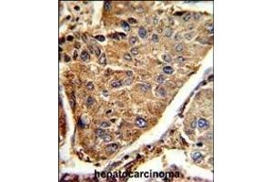 Formalin-fixed and paraffin-embedded human hepatocarcinoma reacted with HEXA Antibody (Center), which was peroxidase-conjugated to the secondary antibody, followed by DAB staining. (Hexosaminidase A antibody  (AA 315-343))