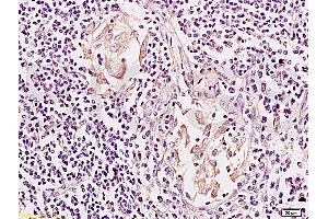 Formalin-fixed and paraffin embedded: human colon carcinoma labeled with Anti-Mesothelin Polyclonal Antibody, Unconjugated (ABIN727608) at 1:200, followed by conjugation to the secondary antibody and DAB staining