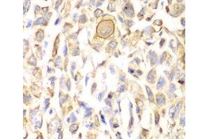 Immunohistochemistry of paraffin-embedded Human lung cancer using CD151 Polyclonal Antibody at dilution of 1:200 (40x lens). (CD151 antibody)