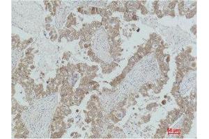 Immunohistochemistry (IHC) analysis of paraffin-embedded Human Lung Carcinoma using MEK-2 Polyclonal Antibody. (MEK2 antibody)