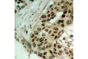 Immunohistochemical analysis of Exportin 5 staining in human ovarian cancer formalin fixed paraffin embedded tissue section. (XPO5 antibody)