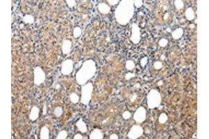 The image on the left is immunohistochemistry of paraffin-embedded Human thyroid cancer tissue using ABIN7193079(XKRX Antibody) at dilution 1/25, on the right is treated with synthetic peptide. (XKRX antibody)