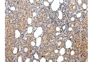 The image on the left is immunohistochemistry of paraffin-embedded Human thyroid cancer tissue using ABIN7193079(XKRX Antibody) at dilution 1/25, on the right is treated with synthetic peptide.