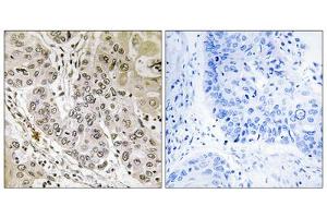 Immunohistochemistry analysis of paraffin-embedded human lung carcinoma tissue, using STK36 antibody.