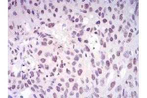 Immunohistochemical analysis of paraffin-embedded ovarian cancer tissues using DNMT1 mouse mAb with DAB staining. (DNMT1 antibody  (AA 1317-1616))