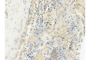 ABIN6264684 and ABIN6279171 at 1/100 staining human lung squamous cell carcinoma by IHC-P. (RECQL4 antibody  (Internal Region))