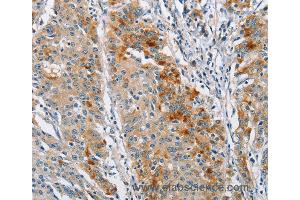 Immunohistochemistry of Human gastric cancer using BCL10 Polyclonal Antibody at dilution of 1:40 (BCL10 antibody)