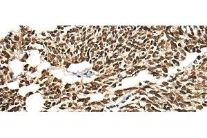 Immunohistochemistry of paraffin-embedded Human lung cancer tissue using MORF4L2 Polyclonal Antibody at dilution of 1:25(x200) (MORF4L2 antibody)