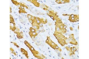 Immunohistochemistry of paraffin-embedded Human liver cancer using CYP2E1 Polyclonal Antibody at dilution of 1:100 (40x lens). (CYP2E1 antibody)