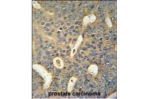 MICALL1 Antibody (C-term) (ABIN654455 and ABIN2844189) immunohistochemistry analysis in formalin fixed and paraffin embedded human prostate carcinoma followed by peroxidase conjugation of the secondary antibody and DAB staining.