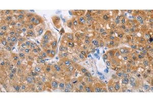 Immunohistochemistry of paraffin-embedded Human liver cancer tissue using BDH1 Polyclonal Antibody at dilution 1:60 (BDH1 antibody)