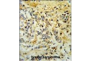 LMBR1L Antibody (C-term) (ABIN653751 and ABIN2843051) IHC analysis in formalin fixed and paraffin embedded breast carcinoma followed by peroxidase conjugation of the secondary antibody and DAB staining. (LMBR1L antibody  (C-Term))
