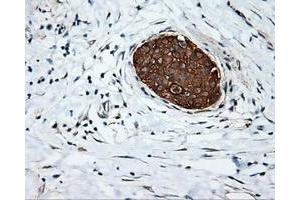 Immunohistochemical staining of paraffin-embedded Adenocarcinoma of colon tissue using anti-SRR mouse monoclonal antibody. (SRR antibody)