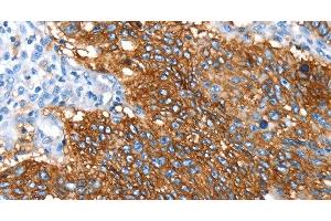 Immunohistochemistry of paraffin-embedded Human lung cancer using SNX5 Polyclonal Antibody at dilution of 1:30 (SNX5 antibody)
