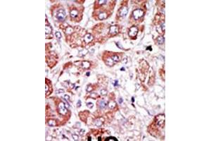 Formalin-fixed and paraffin-embedded human cancer tissue reacted with the primary antibody, which was peroxidase-conjugated to the secondary antibody, followed by DAB staining. (PLAU antibody  (AA 136-166))
