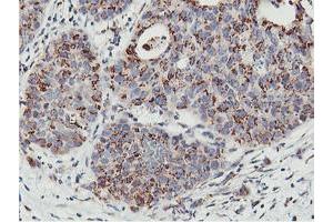 Immunohistochemical staining of paraffin-embedded Carcinoma of Human lung tissue using anti-NMT2 mouse monoclonal antibody. (NMT2 antibody)