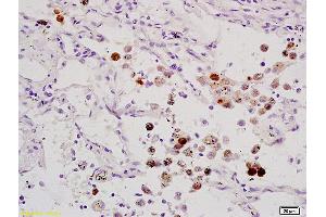 Formalin-fixed and paraffin embedded human lung carcinoma labeled with Anti-ELK1 Polyclonal Antibody, Unconjugated (ABIN685972) at 1:200 followed by conjugation to the secondary antibody and DAB staining. (ELK1 antibody  (AA 301-428))
