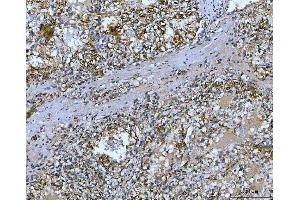 IHC analysis of Carbonic Anhydrase 9/CA9 using anti-Carbonic Anhydrase 9/CA9 antibody (ABIN7600076).