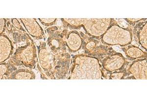 Immunohistochemistry of paraffin-embedded Human thyroid cancer tissue using HORMAD2 Polyclonal Antibody at dilution of 1:45(x200) (HORMAD2 antibody)