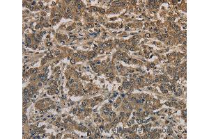 Immunohistochemistry of Human liver cancer using KRT16 Polyclonal Antibody at dilution of 1:30