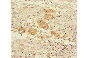 Immunohistochemistry of paraffin-embedded human pancreatic cancer using ABIN7142162 at dilution of 1:100