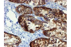 Immunohistochemical staining of paraffin-embedded Adenocarcinoma of Human ovary tissue using anti-DOK7 mouse monoclonal antibody. (DOK7 antibody)