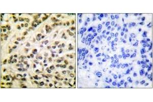 Immunohistochemistry analysis of paraffin-embedded human breast carcinoma tissue, using FLI1 Antibody.