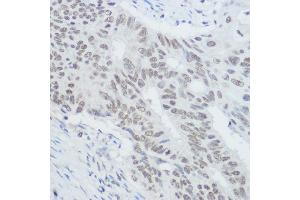 Immunohistochemistry of paraffin-embedded human colon carcinoma using XRCC1 Rabbit pAb (ABIN1683300, ABIN5663662, ABIN5663663, ABIN5663664 and ABIN6213850) at dilution of 1:300 (40x lens). (XRCC1 antibody  (AA 1-320))
