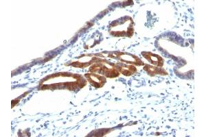 Formalin-fixed, paraffin-embedded human Gastric Carcinoma stained with MUC6 Monoclonal Antibody (SPM598). (MUC6 antibody)