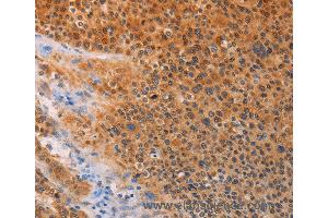 Immunohistochemistry of Human lung cancer using ADHFE1 Polyclonal Antibody at dilution of 1:30
