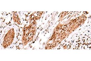 Immunohistochemistry of paraffin-embedded Human esophagus cancer tissue using AK9 Polyclonal Antibody at dilution of 1:60(x200) (Adenylate Kinase 9 antibody)