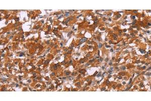 Immunohistochemistry of paraffin-embedded Human thyroid cancer tissue using HSPB6 Polyclonal Antibody at dilution 1:30 (HSPB6 antibody)