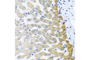 Immunohistochemistry of paraffin-embedded human liver injury using M6PR antibody (ABIN5975018) at dilution of 1/100 (40x lens). (M6PR antibody)