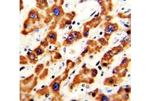 IHC analysis of FFPE human hepatocarcinoma with Prohibitin antibody (Prohibitin antibody  (AA 92-121))