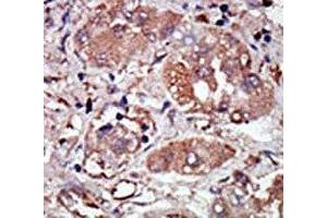 IHC analysis of FFPE human hepatocarcinoma stained with the PRKR antibody (EIF2AK2 antibody  (AA 519-550))
