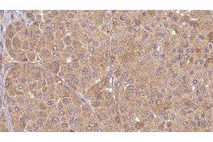 ABIN6277525 at 1/100 staining Human Melanoma tissue by IHC-P. (Urotensin 2 antibody  (C-Term))