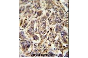 FL Antibody (C-term) (ABIN651674 and ABIN2840355) immunohistochemistry analysis in formalin fixed and paraffin embedded human cervix carcinoma followed by peroxidase conjugation of the secondary antibody and DAB staining. (AAGAB antibody  (C-Term))