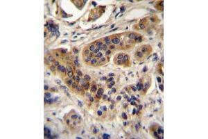 ACOX1 Antibody (N-term) A immunohistochemistry analysis in formalin fixed and paraffin embedded human bladder carcinoma followed by peroxidase conjugation of the secondary antibody and DAB staining. (ACOX1 antibody  (N-Term))