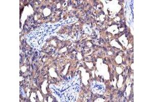 NME1 antibody was used for immunohistochemistry at a concentration of 4-8 ug/ml. (NME1 antibody  (N-Term))